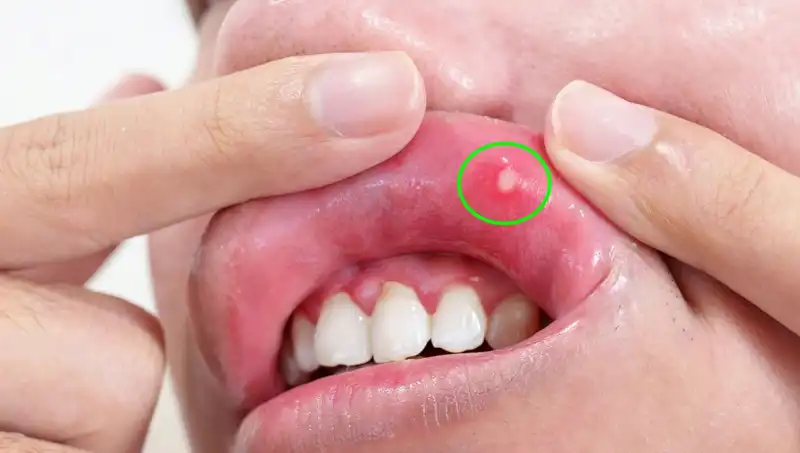 Vücudunuzdaki 5 Belirgin B Vitamini Eksikliği Belirtisi