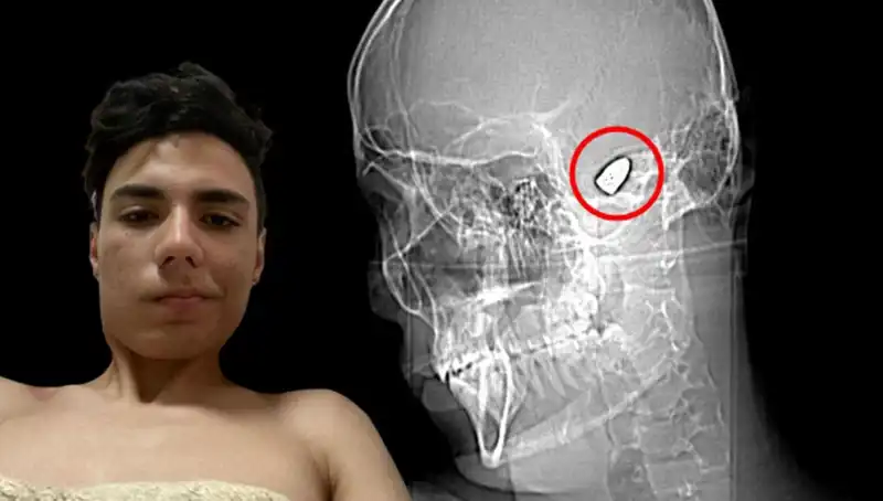 Kafasında Patlamaya Hazır Bomba Taşıyan Genç, Hayatını Korku Dolu Anlarla Geçiriyor